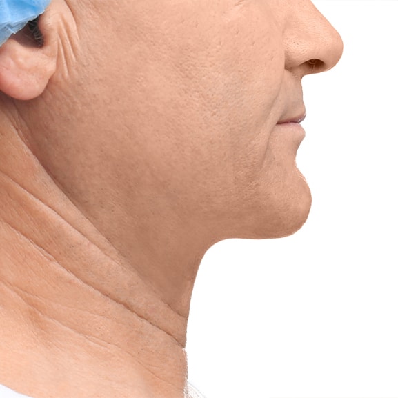 After facial contouring treatment