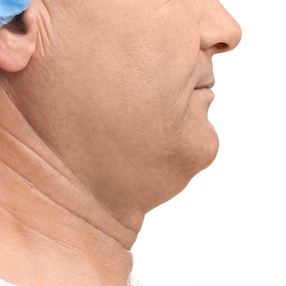 Before facial contouring treatment