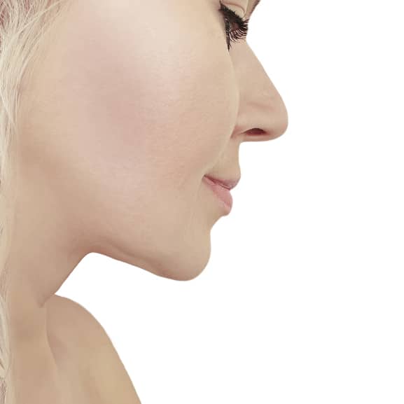 After cryotherapy double chin treatment