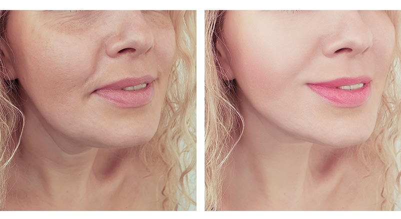 Before and after skin treatment