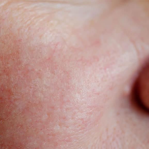 After thread vein removal