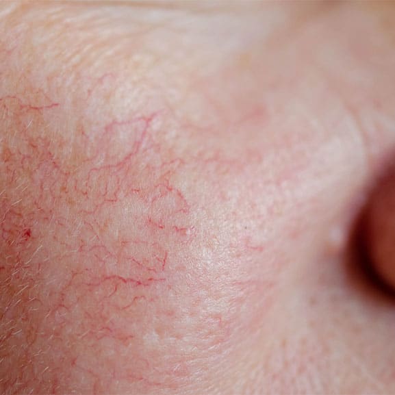 Before thread vein removal