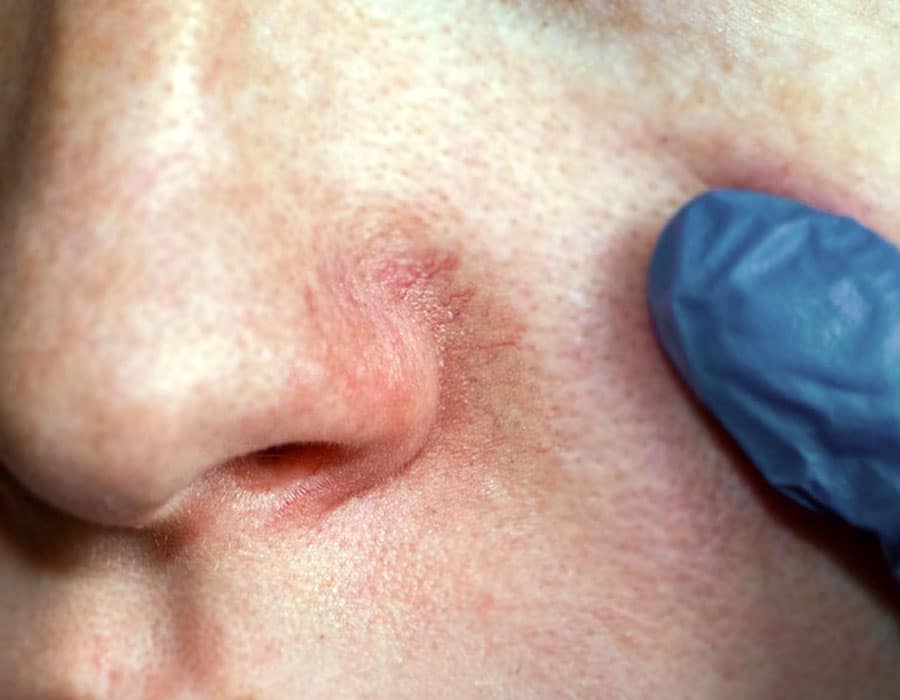 What are thread veins?