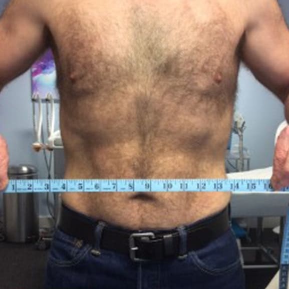 After LED Phototherapy