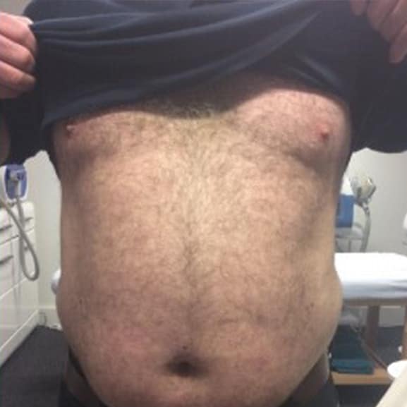 Before LED Phototherapy