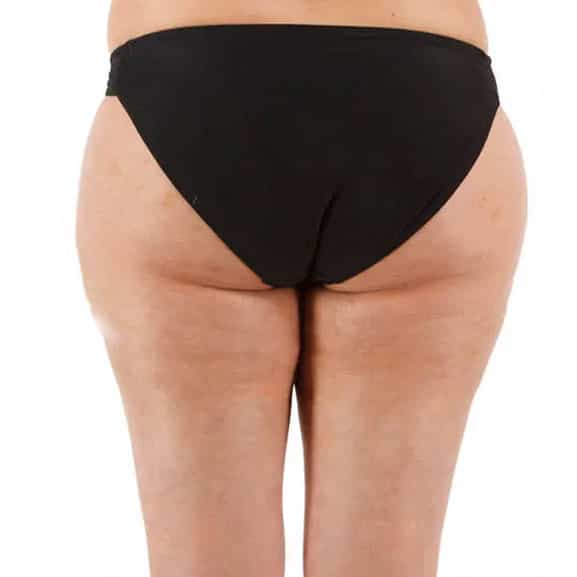 After body contouring treatment with lipofirm pro