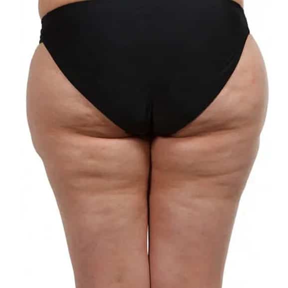 Before body contouring treatment with lipofirm pro