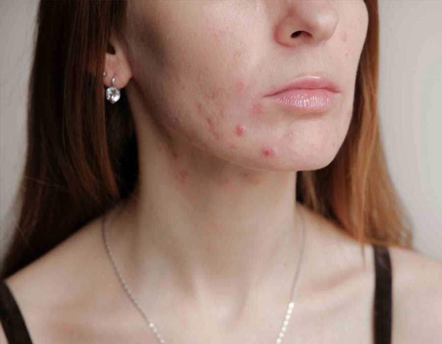 Best Acne Treatment UK