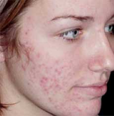 Acne scars before and after