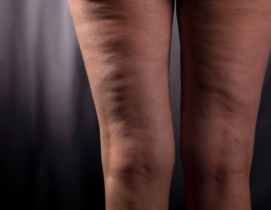 cellulite-treatment-before-02 What is cellulite?