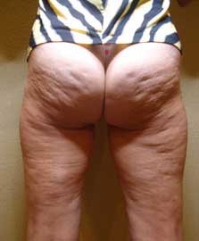 Before cellulite treatment in Brighton