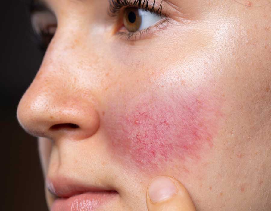 Rosacea Symptoms Clinic 33