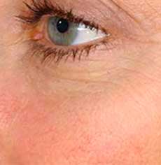 Rosacea pictures before and after