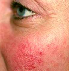 Rosacea pictures before and after