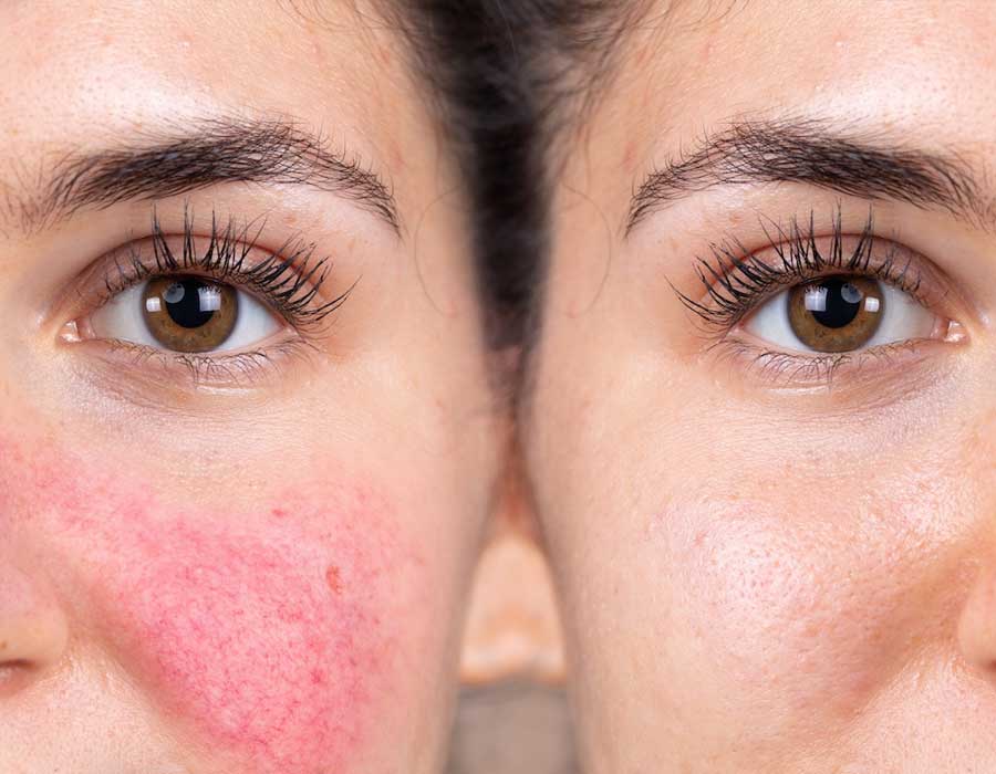 Rosacea before & after