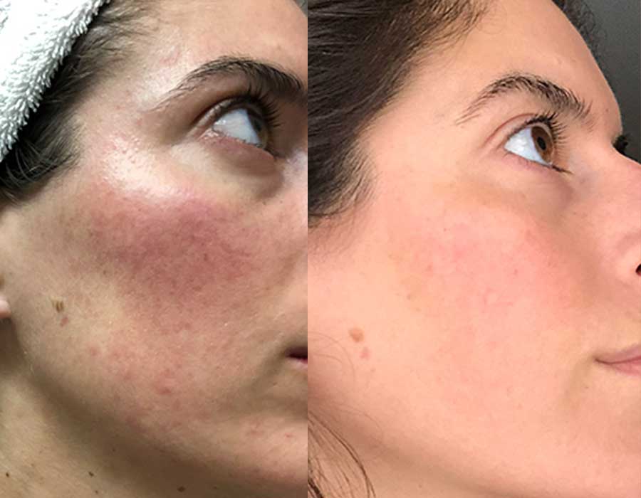 Rosacea before & after Clinic 33