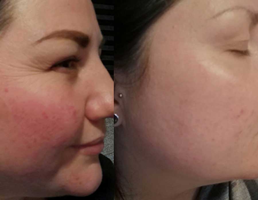 Rosacea before & after Clinic 33