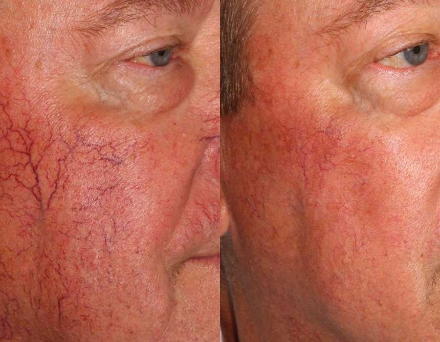 Rosacea before & after