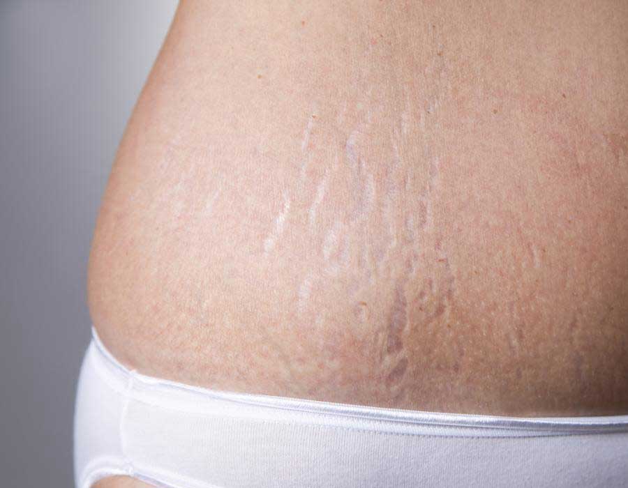 stretch-marks-001 What causes stretch marks?