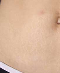 After stretch mark treatment