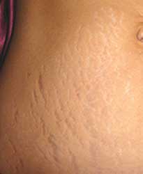 Before stretch mark treatment