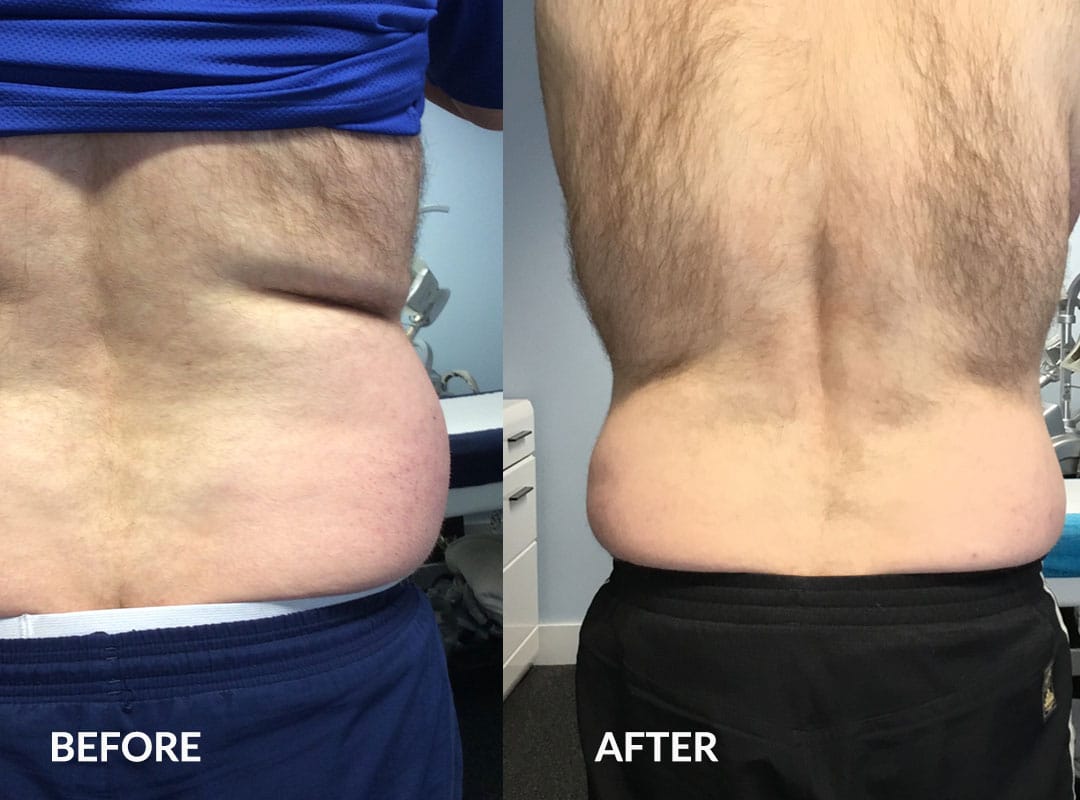 Before and after cryotherapy