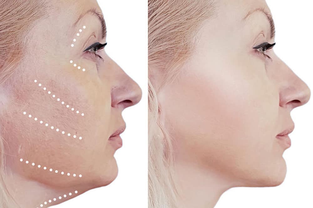 Skin tightening treatment