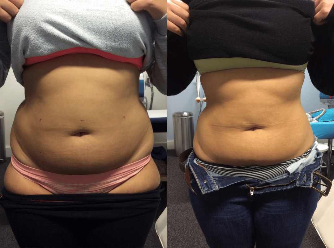 Before and after cryotherapy