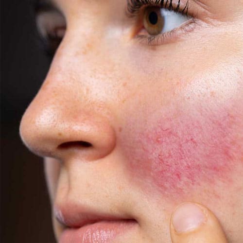Rosacea Treatment in Brighton
