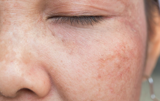 Skin Clinic Brighton