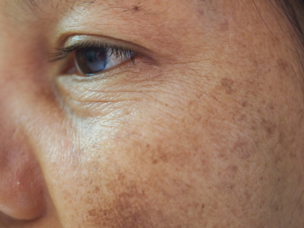 Treatment For Sun Damage & Pigmentation in Brighton
