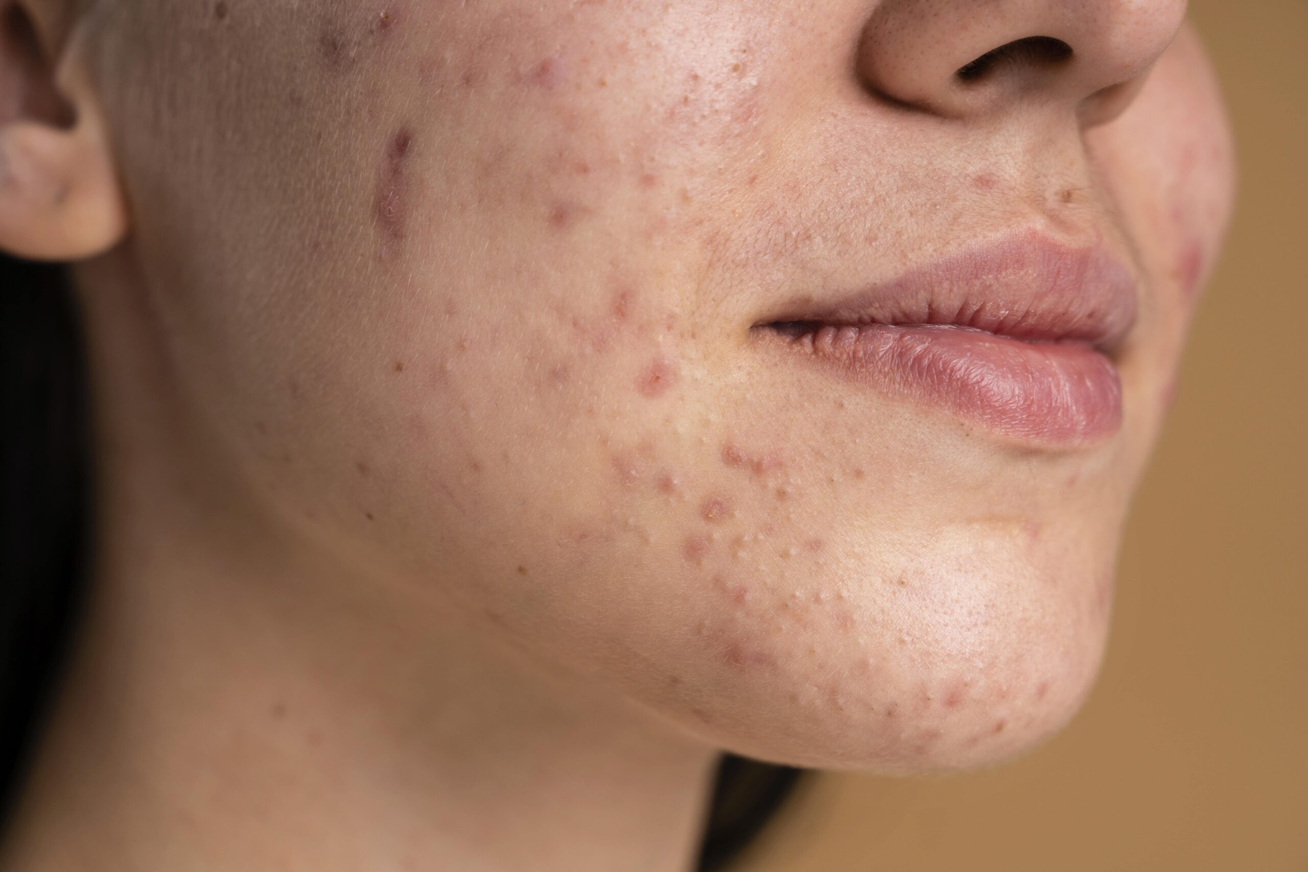 acne treatments in Brighton
