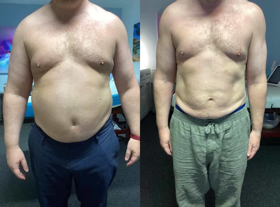 Weight loss