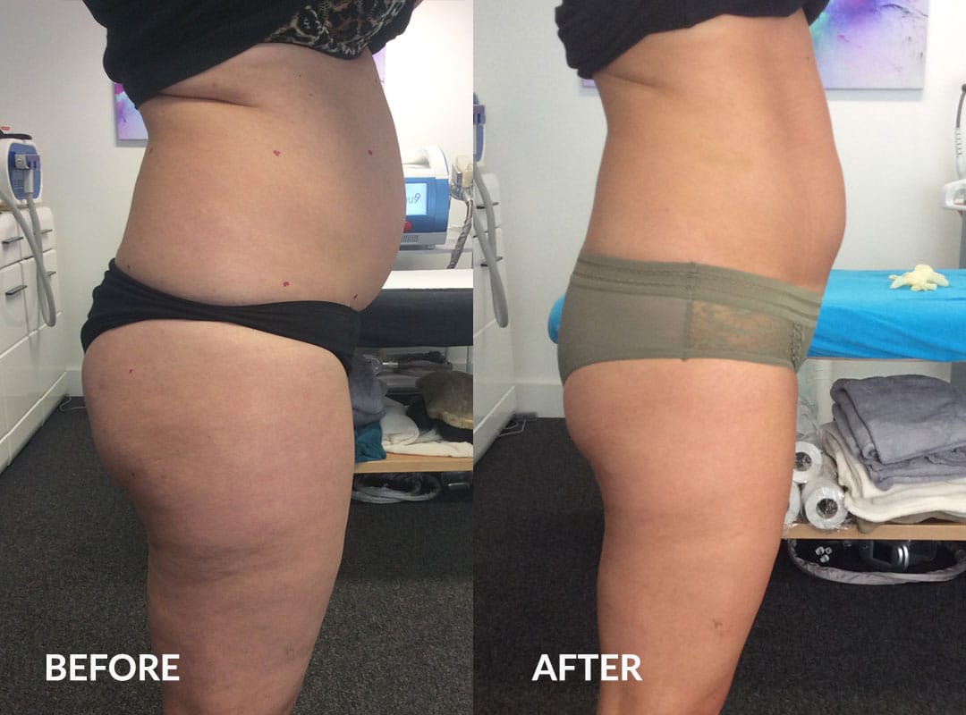 emma-before-and-after-002 Cellulite reduction