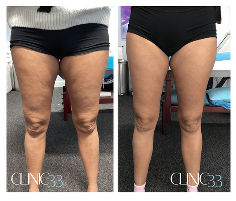 Skin Tightening, Lifting & Toning Lipofirm legs cellulite treatment before and after