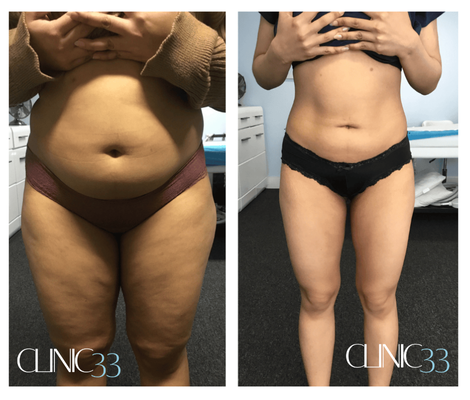 Fat Freezing (Cryotherapy) cryotherapy treatment before and after