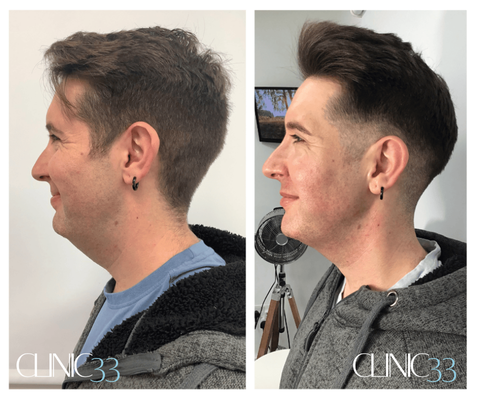 Lipofirm jawline treatment before and after Lipofirm jawline treatment before and after
