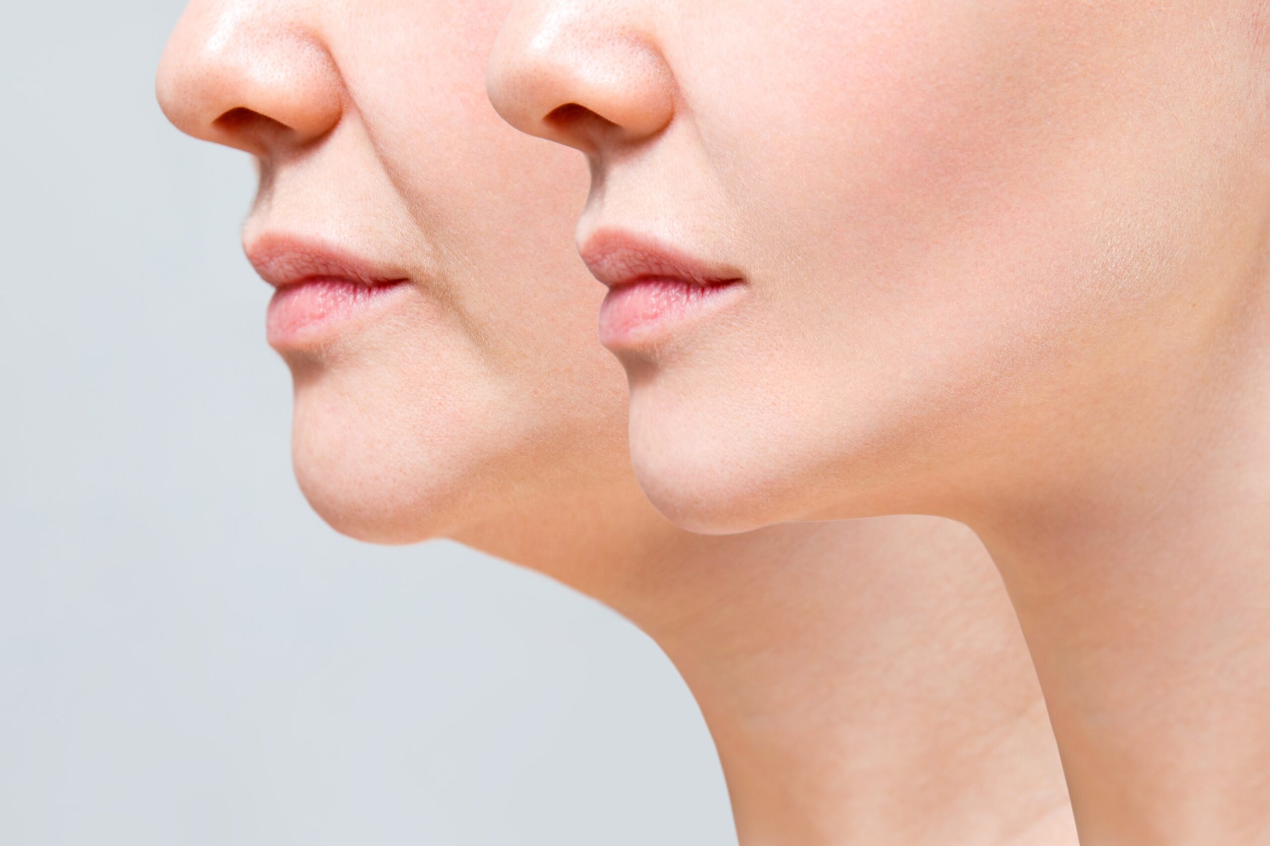 A,Close,Portrait,Of,An,Aged,Woman,Before,And,After Stubborn chin fat