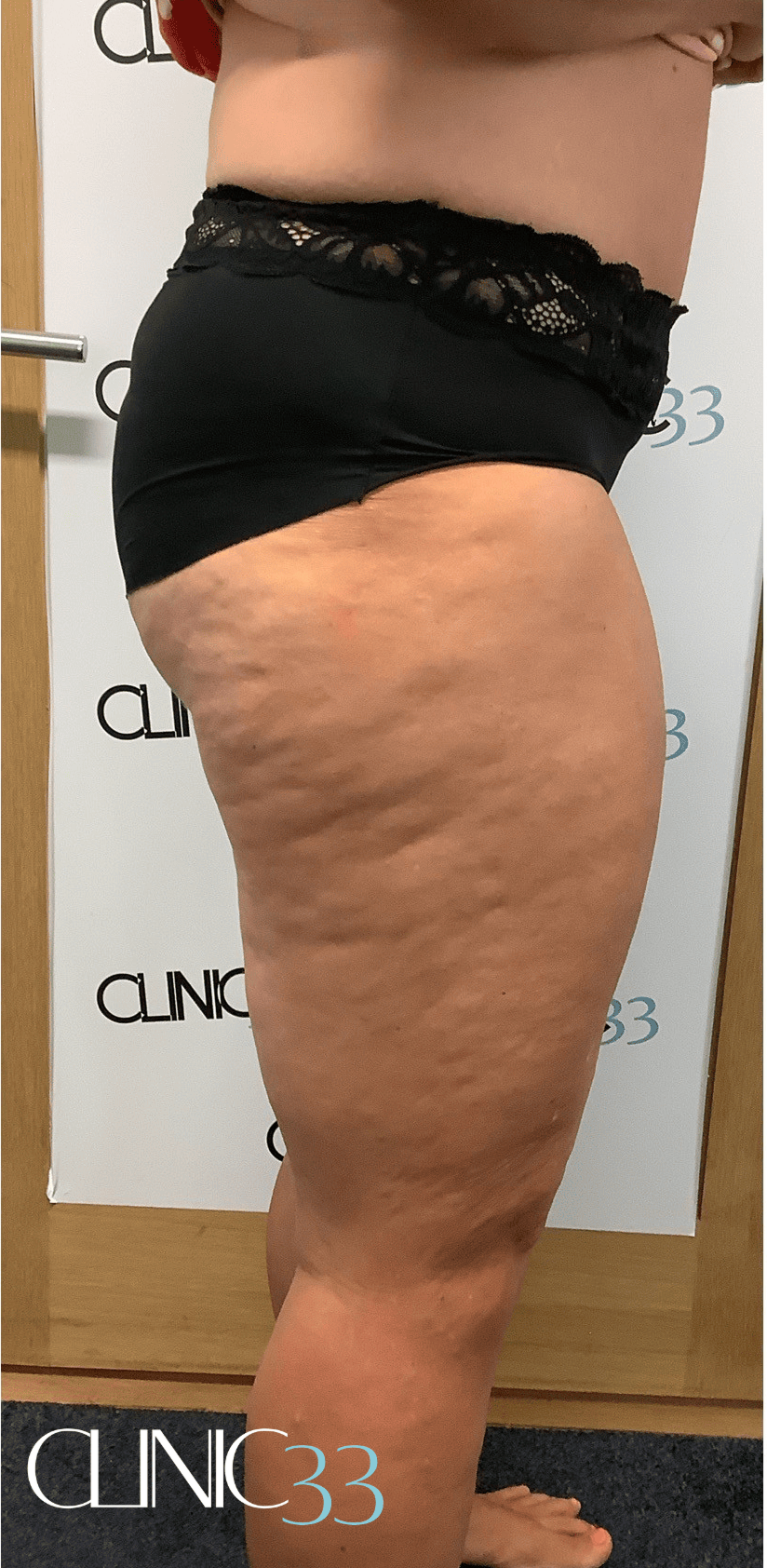 BA-lipofirm-thighs 1