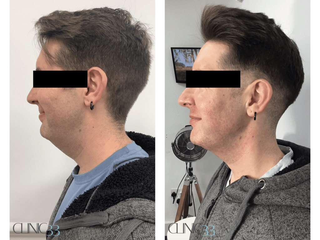 Lipofirm double chin fat reduction, jawline shaping & skin tightening