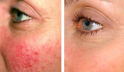 Rosacea / Pigmentation Brighton & Hove aesthetic clinic