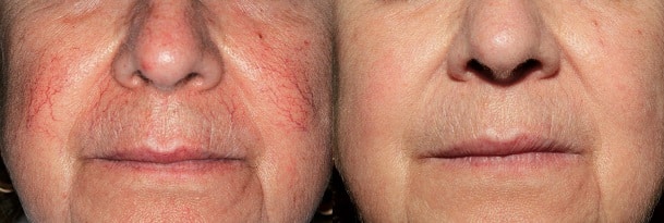 The Benefits Of Red Thread Veins Treatment