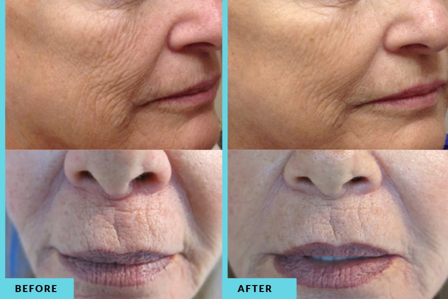 non-surgical face lift