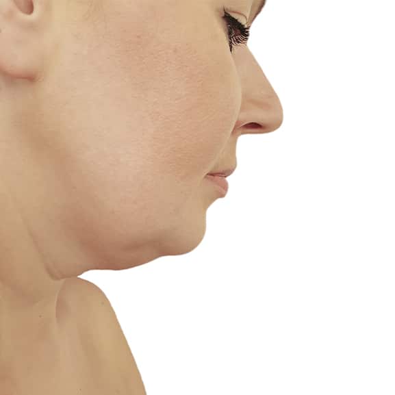 Before cryotherapy double chin treatment