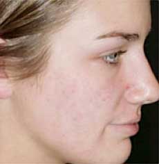 Acne scars before and after