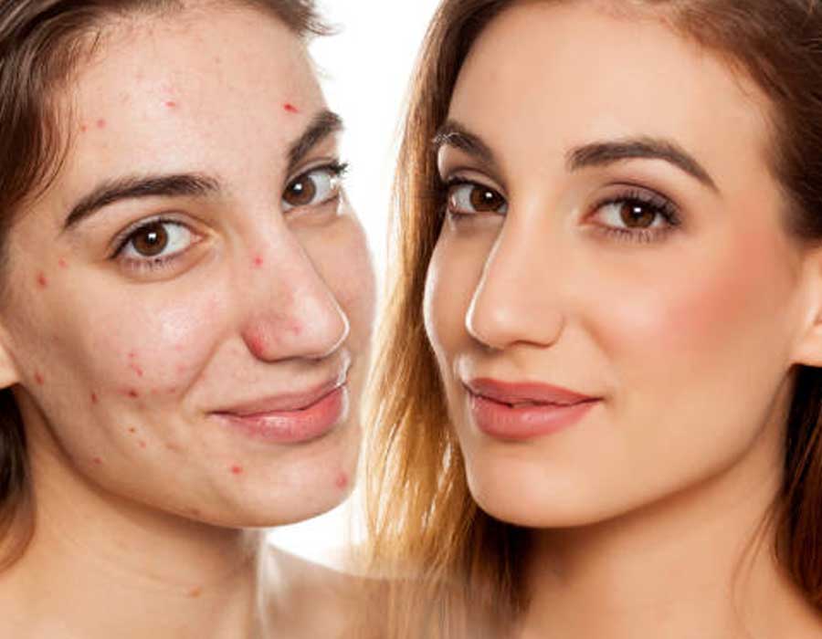 Acne Before & After