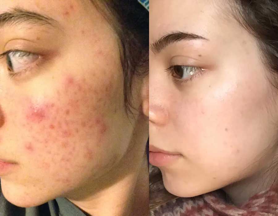 Acne scar removal