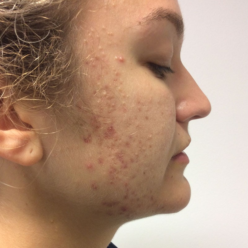 Dermalux before and after