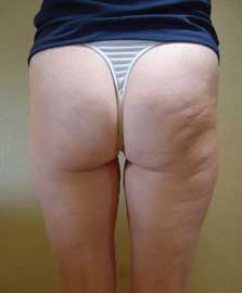 After cellulite treatment in Brighton