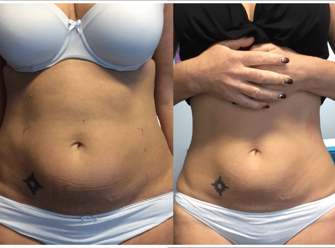 Bra Fat Treatment with CoolSculpt Fat Freezing at Define Medical Clinic  Beaconsfield